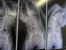 A young British woman successfully operated on in China for rare double scoliosis