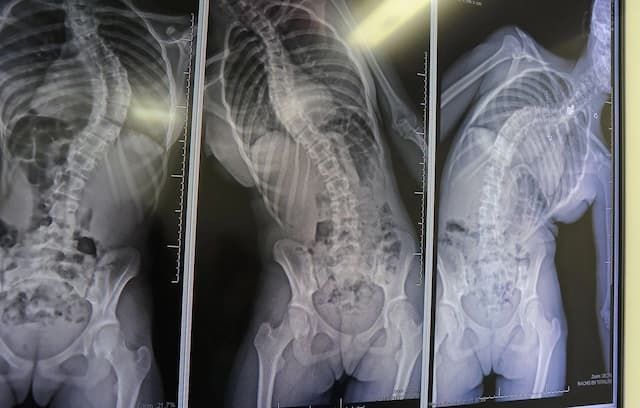 China: A Young British Woman Successfully Operated on in China for Rare Double Scoliosis